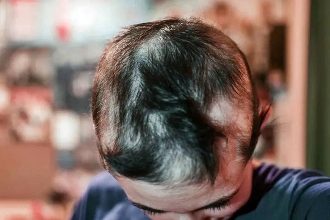 11 köyde yüzlerce kişi sabah kel olarak uyandı! Saç döken gizemli salgının nedeni o olabilir 3